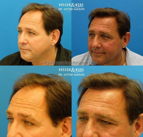 Hair transplantation surgery before and after pictures