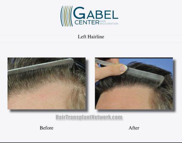 Hair restoration procedure before and after results