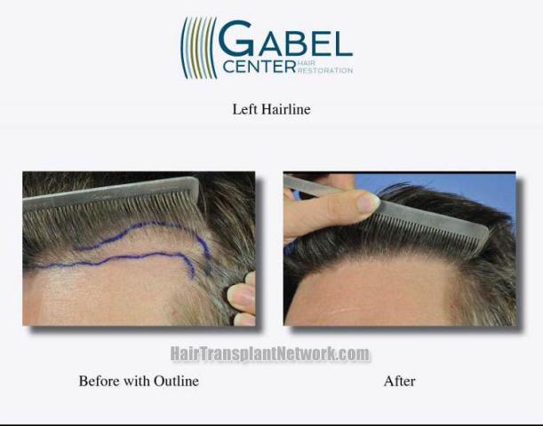 Hair transplant surgery before and after pictures