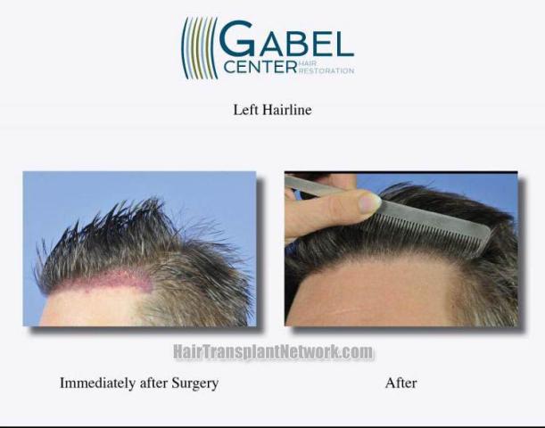 Hair transplantation surgery before and after pictures