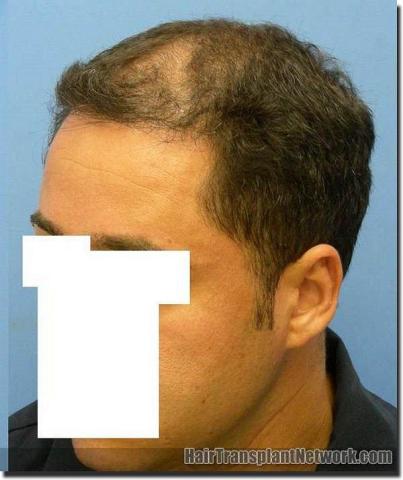 Hair restoration procedure results