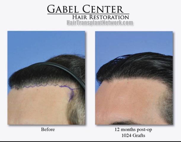 Hair transplant surgery before and after pictures