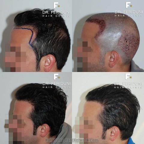 Hair transplantation surgery before and after images