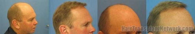 Hair transplant results from 4365 grafts