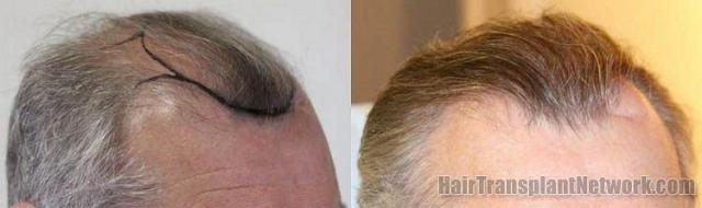 Hair restoration procedure results