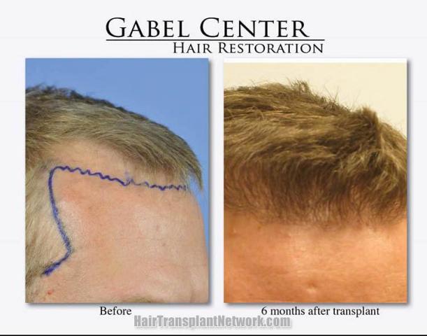 Hair transplantation surgery before and after images