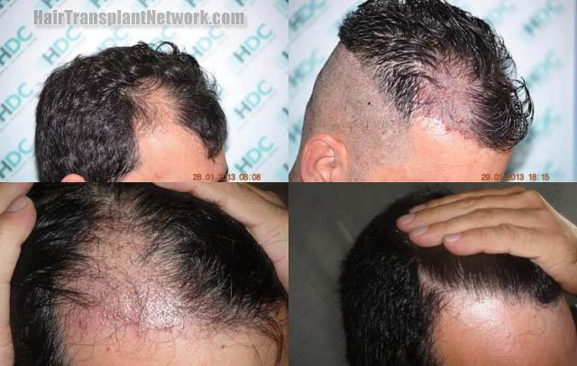 Hair transplantation surgery before and after images