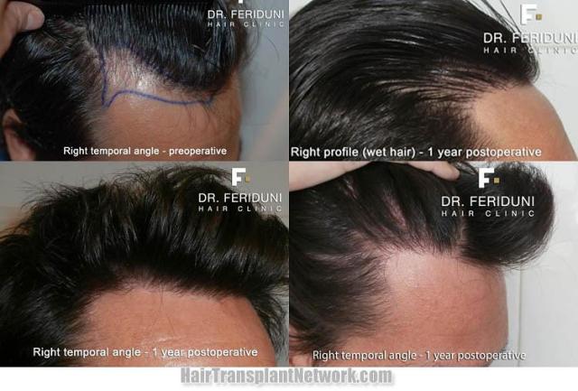 Hair restoration surgery before and after photos