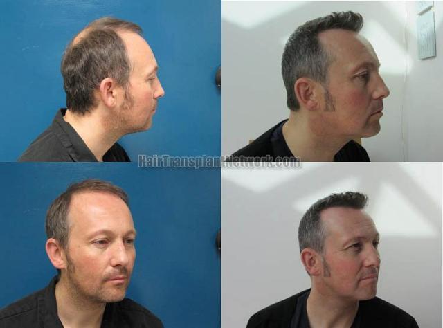 Hair transplantation surgery before and after images