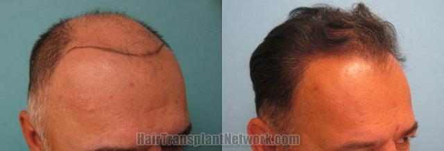 Hair transplantation surgery before and after pictures