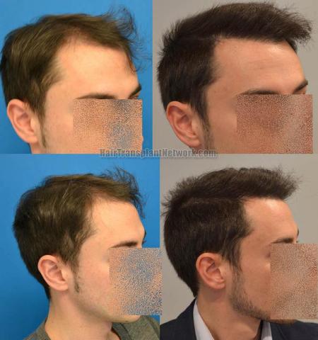 Hair transplantation surgery before and after photos