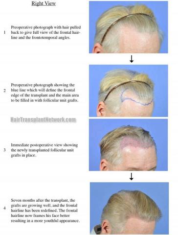 Hair transplantation surgery before and after images