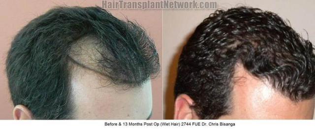 Hair transplantation surgery before and after images