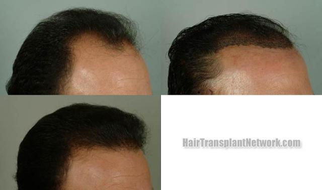 Hair transplantation surgery before and after images