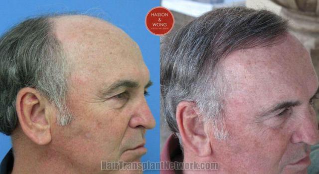 Hair transplantation surgery before and after images