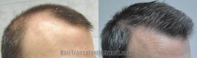 Surgical hair transplantation result photographs