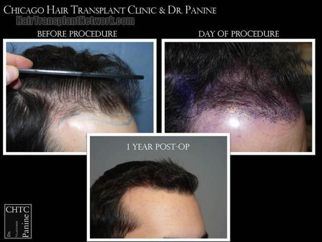 Hair transplantation surgery before and after pictures