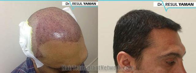 Hair transplantation surgery before and after images