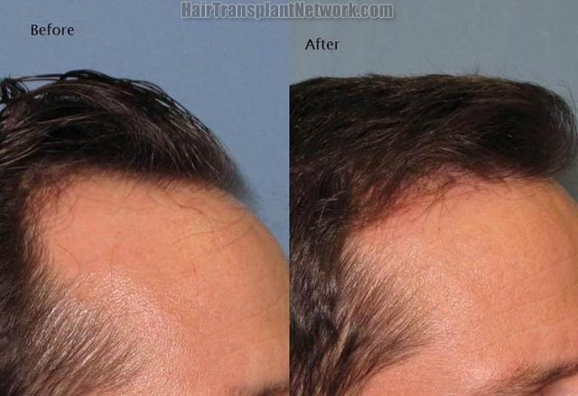 Hair transplantation surgery before and after images