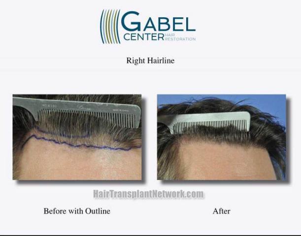 Hair restoration procedure before and after results