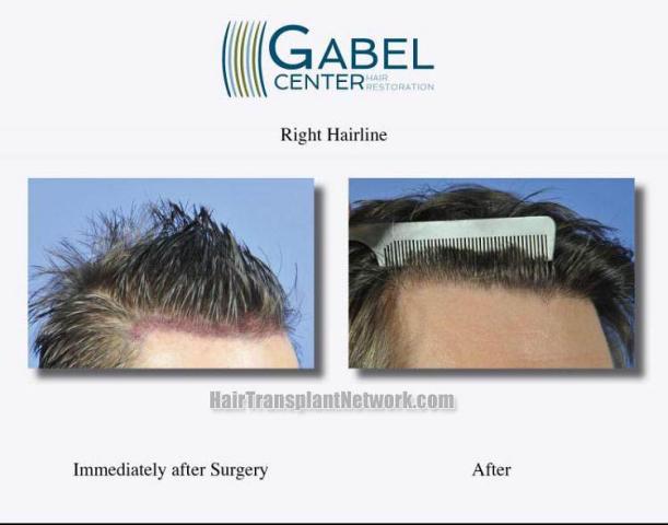 Hair transplantation surgery before and after pictures