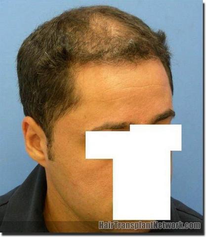 Hair restoration procedure results