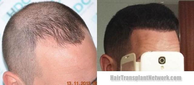 Hair transplantation surgery before and after photos