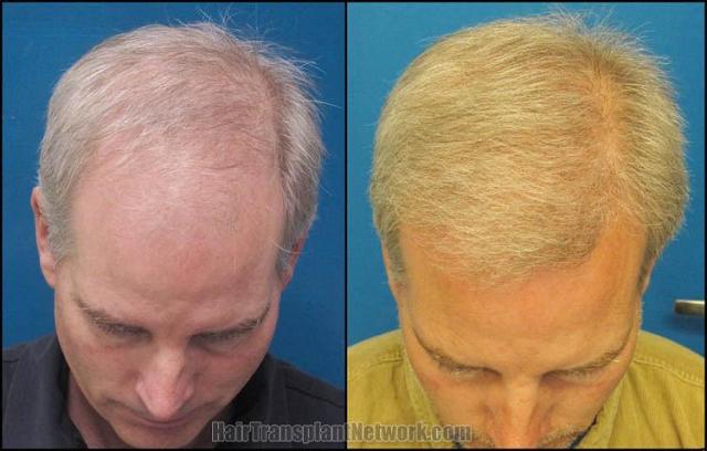 Hair transplantation surgery before and after images