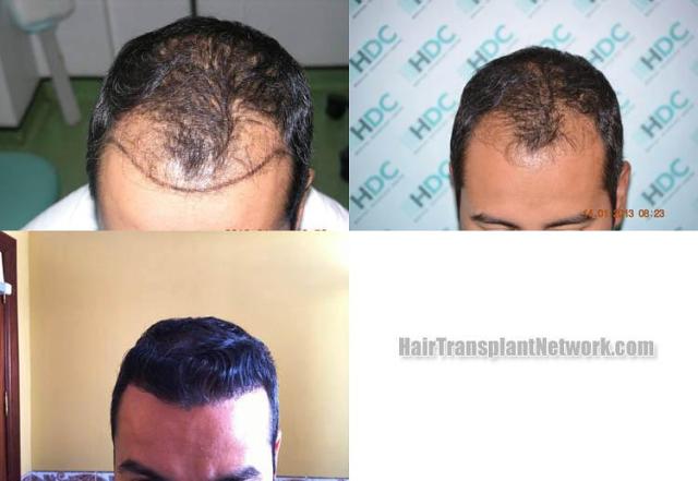 Hair restoration surgery before and after images