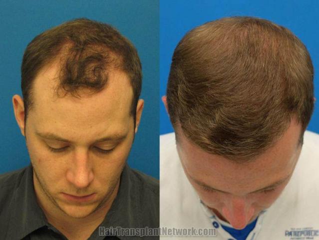 Hair restoration surgery before and after images