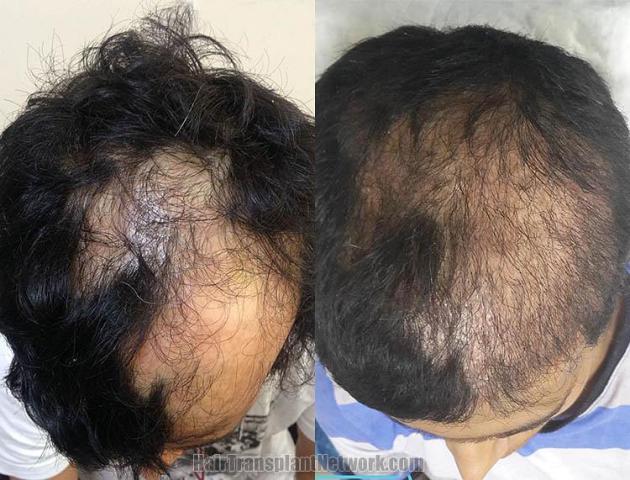 Top view before and after hair restoration results