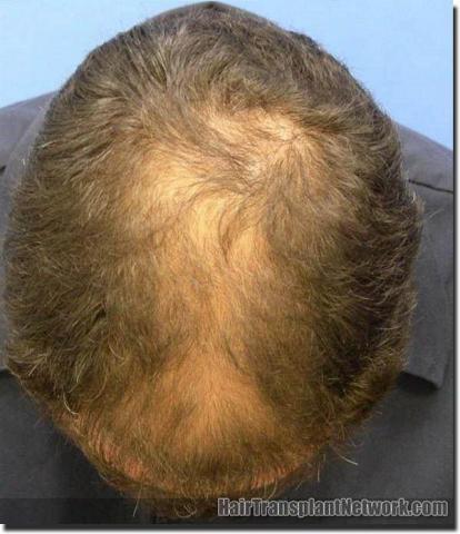 Hair restoration procedure results