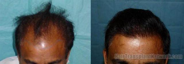 View from the top showing hair transplant results