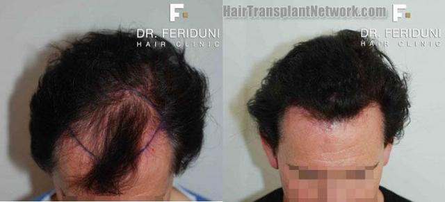 Hair restoration procedure before and after pictures