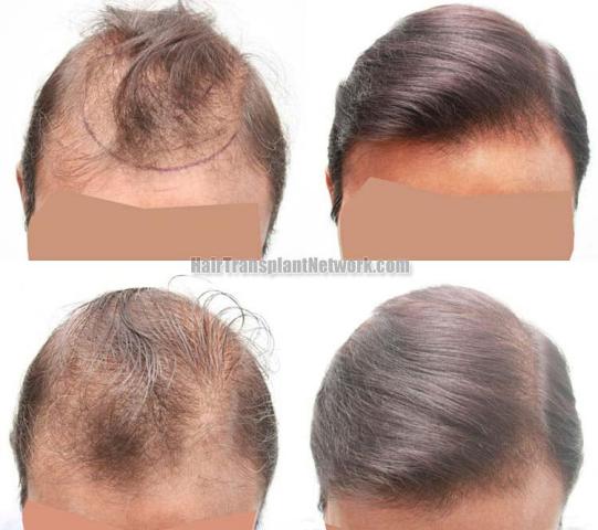 Before and after hair transplant procedure images