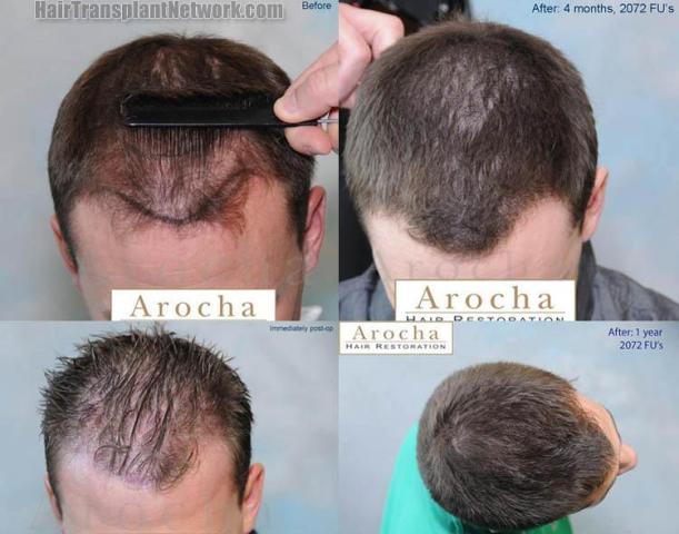 Hair restoration procedure before and after results