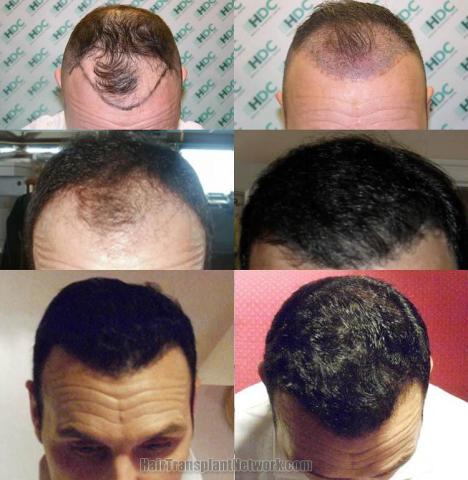 Top view before and after hair restoration results