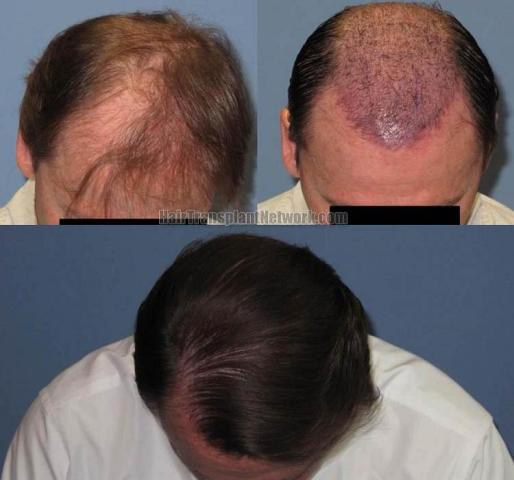 Hair transplantation surgery before and after photos