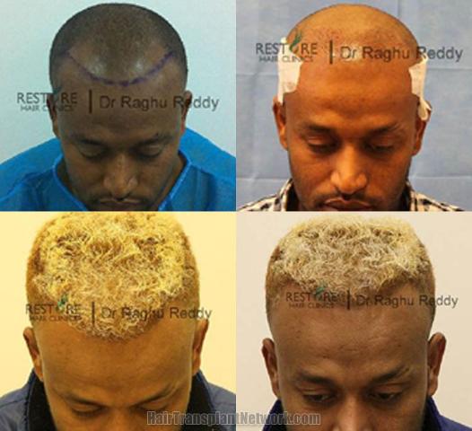 Hair transplantation surgery before and after photos