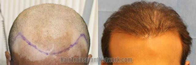 Hair restoration procedure before and after results