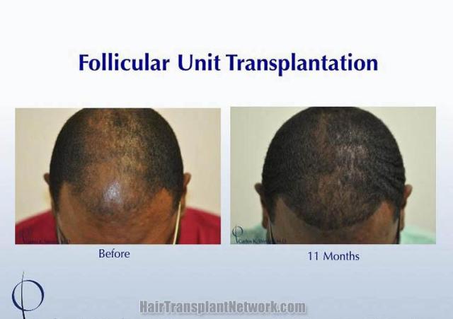 Hair transplantation surgery before and after photos