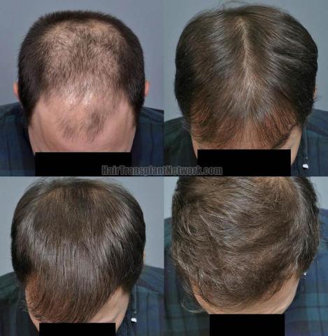 Hair restoration procedure before and after pictures