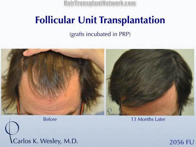 Hair transplantation surgery before and after photos