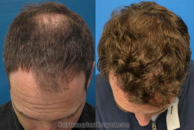 Top view before and after hair restoration results