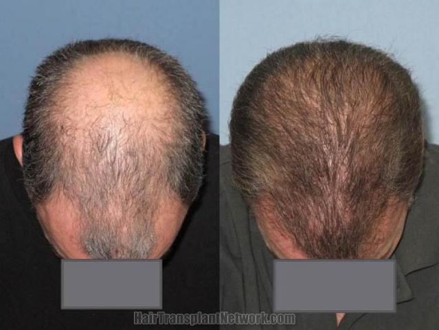 Hair transplantation surgery before and after photos