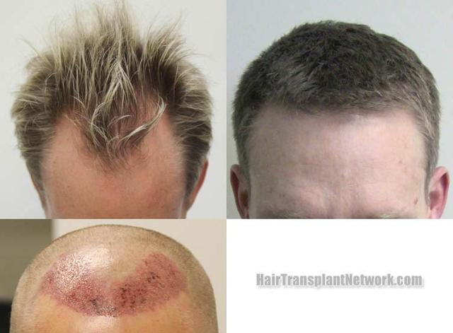 Hair transplantation surgery before and after photos