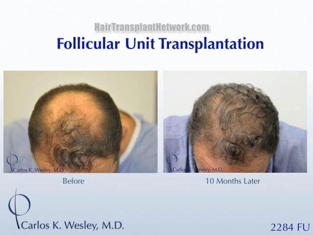 Hair transplantation surgery before and after pictures