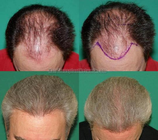 Hair transplantation surgery before and after photos