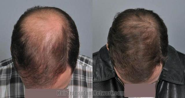 Top view before and after hair restoration results