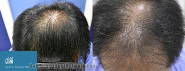 Top view before and after hair restoration results